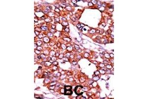 Formalin-fixed and paraffin-embedded human cancer tissue reacted with CDC25A (phospho T506) polyclonal antibody  which was peroxidase-conjugated to the secondary antibody followed by AEC staining.