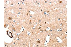 The image on the left is immunohistochemistry of paraffin-embedded Human brain tissue using ABIN7189570(AARS Antibody) at dilution 1/50, on the right is treated with synthetic peptide. (AARS antibody)