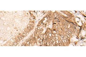 Immunohistochemistry of paraffin-embedded Human colorectal cancer tissue using HIPK3 Polyclonal Antibody at dilution of 1:60(x200) (HIPK3 antibody)