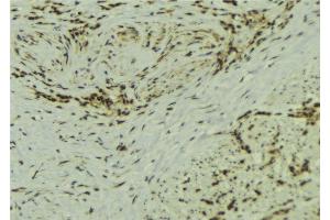 ABIN6273106 at 1/100 staining Human breast cancer tissue by IHC-P. (SS18L1 antibody)