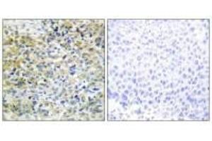 Immunohistochemistry analysis of paraffin-embedded human liver carcinoma tissue using CARKL antibody. (SHPK antibody  (N-Term))