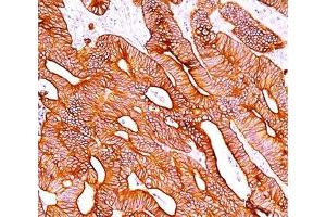 IHC staining of colon carcinoma with pan Cytokeratin antibody cocktail AE1 + AE3. (pan Keratin antibody)