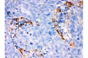 FCGRT was detected in paraffin-embedded sections of human lung cancer tissues using rabbit anti- FCGRT Antigen Affinity purified polyclonal antibody at 1 μg/mL. (FcRn antibody  (AA 56-291))