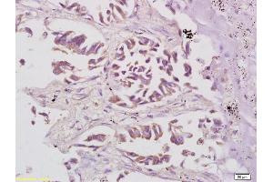 Formalin-fixed and paraffin embedded human lung carcinoma labeled with Anti Phospho-S6 Ribosomal Protein (Ser235+Ser236) Polyclonal Antibody, Unconjugated (ABIN745583) at 1:200 followed by conjugation to the secondary antibody and DAB staining (RPS6 antibody  (pSer235, pSer236))