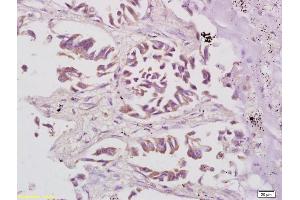 Formalin-fixed and paraffin embedded human lung carcinoma labeled with Anti Phospho-S6 Ribosomal Protein (Ser235+Ser236) Polyclonal Antibody, Unconjugated (ABIN745583) at 1:200 followed by conjugation to the secondary antibody and DAB staining
