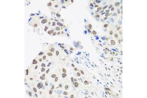 Immunohistochemistry of paraffin-embedded human prostate cancer using DDX39B antibody (ABIN5974669) at dilution of 1/100 (40x lens). (DDX39B antibody)