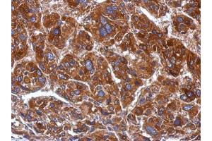 IHC-P Image Immunohistochemical analysis of paraffin-embedded human hepatoma, using mtRNA polymerase, antibody at 1:500 dilution. (POLRMT antibody  (Center))