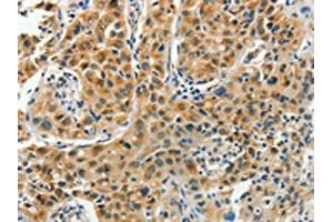 The image on the left is immunohistochemistry of paraffin-embedded Human lung cancer tissue using ABIN7191847(PFDN6 Antibody) at dilution 1/35, on the right is treated with synthetic peptide. (PFDN6 antibody)