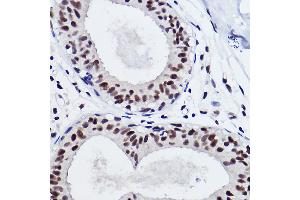 Immunohistochemistry of paraffin-embedded human breast cancer using SNRP Rabbit mAb (ABIN7270365) at dilution of 1:100 (40x lens). (SNRPA1 antibody)