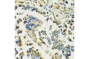 Immunohistochemistry of paraffin-embedded human colon carcinoma using SLC25 antibody (ABIN6132660, ABIN6147903, ABIN6147904 and ABIN6224187) at dilution of 1:100 (40x lens). (SLC25A11 antibody  (AA 1-314))