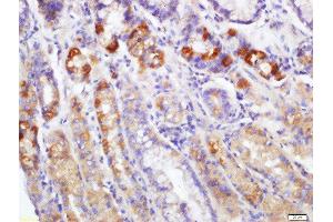 Formalin-fixed and paraffin embedded human gastric carcinoma labeled with Rabbit Anti-EDA2R Polyclonal Antibody, Unconjugated  at 1:200 followed by conjugation to the secondary antibody and DAB staining