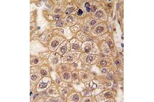 Formalin-fixed and paraffin-embedded human hepatocarcinoma tissue reacted with BAR2 Antibody , which was peroxidase-conjugated to the secondary antibody, followed by DAB staining. (beta 2 Adrenergic Receptor antibody  (Ser261))