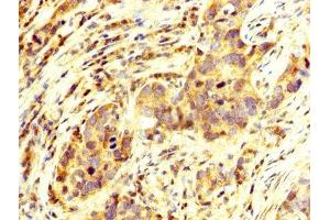 IHC image of ABIN7155839 diluted at 1:250 and staining in paraffin-embedded human pancreatic cancer performed on a Leica BondTM system. (OTX2 antibody  (AA 1-297))