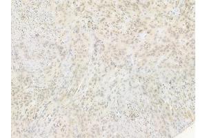 ABIN6255118 and ABIN6267547 at 1/100 staining human tongue carcinoma by IHC-P. (VASP antibody  (pSer239))