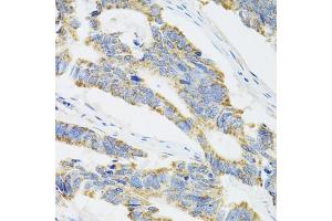 Immunohistochemistry of paraffin-embedded human colon carcinoma using CYP1A1 antibody (ABIN5971186) at dilution of 1/100 (40x lens). (CYP1A1 antibody)