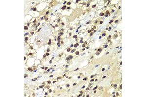 Immunohistochemistry of paraffin-embedded human kidney cancer using PRKDC antibody at dilution of 1:100 (x400 lens). (PRKDC antibody)