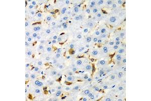 Immunohistochemistry of paraffin-embedded human liver injury using CD68 antibody (ABIN5975414) at dilution of 1/100 (40x lens). (CD68 antibody)