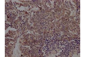 IHC image of ABIN7127369 diluted at 1:100 and staining in paraffin-embedded human lung cancer performed on a Leica BondTM system. (Recombinant BMI1 antibody)