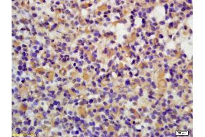 Formalin-fixed and paraffin embedded human brain glioblastoma labeled with Anti-Phospho-Lyn (Tyr397) Polyclonal Antibody, Unconjugated (ABIN743618) at 1:200 followed by conjugation to the secondary antibody and DAB staining (LYN antibody  (pTyr397))
