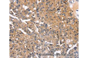 Immunohistochemistry of Human esophagus cancer using SLC2A2 Polyclonal Antibody at dilution of 1:35 (SLC2A2 antibody)
