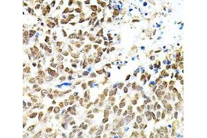 Immunohistochemistry of paraffin-embedded Human lung cancer using PNKP Polyclonal Antibody at dilution of 1:100 (40x lens).