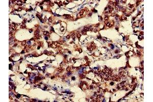 Immunohistochemistry of paraffin-embedded human gastric cancer using ABIN7149162 at dilution of 1:100 (COX IV antibody  (Isoform 1))