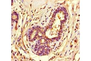Immunohistochemistry of paraffin-embedded human breast cancer using ABIN7155525 at dilution of 1:100 (SUV39H1 antibody  (AA 179-412))