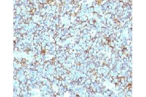 Formalin-fixed, paraffin-embedded human Ewing's sarcoma stained with CD99 antibody (MIC2/877). (CD99 antibody)