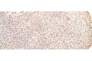 Immunohistochemistry of paraffin-embedded Human cervical cancer tissue using ZNF263 Polyclonal Antibody at dilution of 1:30(x200) (ZNF263 antibody)