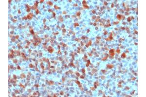 Formalin-fixed, paraffin-embedded human Melanoma stained with S100B Rabbit Polyclonal Antibody. (S100B antibody)