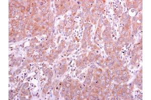 IHC-P Image PGD antibody detects PGD protein at cytoplasm on human breast carcinoma by immunohistochemical analysis.