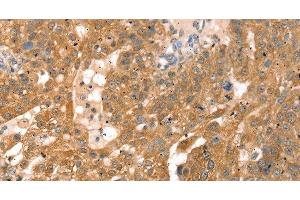 Immunohistochemistry of paraffin-embedded Human breast cancer using RPS6KA1 Polyclonal Antibody at dilution of 1:30 (RPS6KA1 antibody)