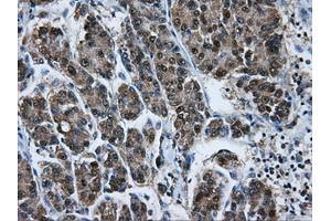 Immunohistochemical staining of paraffin-embedded Carcinoma of liver tissue using anti-HSPA1Amouse monoclonal antibody. (HSP70 1A antibody)