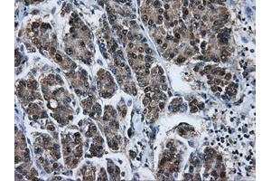 Immunohistochemical staining of paraffin-embedded Carcinoma of liver tissue using anti-HSPA1Amouse monoclonal antibody.