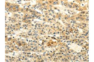 The image on the left is immunohistochemistry of paraffin-embedded Human liver cancer tissue using ABIN7190020(BRWD1 Antibody) at dilution 1/20, on the right is treated with synthetic peptide. (BRWD1 antibody)