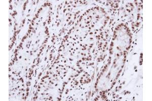 IHC-P Image Immunohistochemical analysis of paraffin-embedded A549 xenograft, using Progesterone receptor, antibody at 1:100 dilution. (Progesterone Receptor antibody  (N-Term))