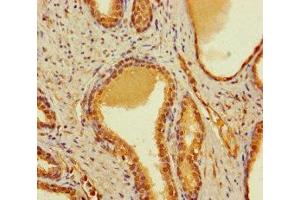 Immunohistochemistry of paraffin-embedded human prostate cancer using ABIN7148034 at dilution of 1:100 (CBWD2 antibody  (AA 96-395))