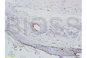 Formalin-fixed and paraffin embedded mouse cancer tissue labeled with Anti-AGPAT4 Polyclonal Antibody, Unconjugated (ABIN708671) at 1:200 followed by conjugation to the secondary antibody, (SP-0023), and DAB staining (AGPAT4 antibody  (AA 231-330))