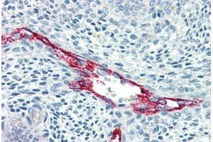 Human Uterus, Vessels (formalin-fixed, paraffin-embedded) stained with F8 antibody ABIN396921 at 10 ug/ml followed by biotinylated anti-mouse IgG secondary antibody ABIN481714, alkaline phosphatase-streptavidin and chromogen. (Factor VIII antibody)