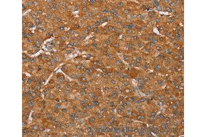 Immunohistochemistry of Human liver cancer using PAGE5 Polyclonal Antibody at dilution of 1:55