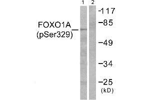 Immunohistochemistry analysis of paraffin-embedded human breast carcinoma tissue using FOXO1A (Phospho-Ser329) antibody. (FOXO1 antibody  (pSer329))