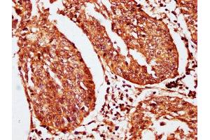 IHC image of ABIN7163536 diluted at 1:200 and staining in paraffin-embedded human cervical cancer performed on a Leica BondTM system. (SERPINB2 antibody  (AA 293-389))