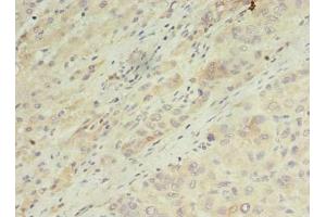Immunohistochemistry of paraffin-embedded human liver cancer using ABIN7143481 at dilution of 1:100 (ARL14 antibody  (AA 2-192))