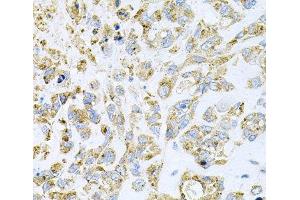 Immunohistochemistry of paraffin-embedded Human lung cancer using HDAC3 Polyclonal Antibody at dilution of 1:100 (40x lens). (HDAC3 antibody)