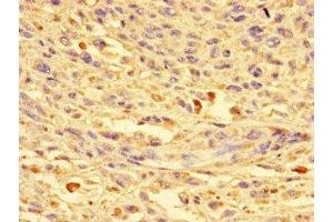 Immunohistochemistry of paraffin-embedded human melanoma using ABIN7149360 at dilution of 1:100 (CKAP2L antibody  (AA 246-413))