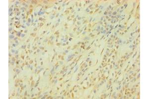 Immunohistochemistry of paraffin-embedded human breast cancer using ABIN7153564 at dilution of 1:100 (SNCG antibody  (AA 1-127))