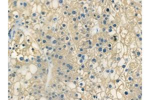 ABIN6266367 and ABIN6273361 at 1/100 staining human hepatocellular carcinoma by IHC-P. (LRRC42 antibody  (N-Term))