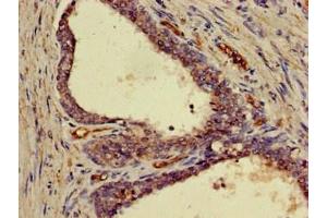 Immunohistochemistry of paraffin-embedded human prostate cancer using ABIN7152845 at dilution of 1:100 (FRS2 antibody  (AA 116-387))