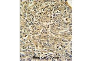 Merlin Antibody (N-term) (ABIN390756 and ABIN2841014) IHC analysis in formalin fixed and paraffin embedded human lung carcinoma followed by peroxidase conjugation of the secondary antibody and DAB staining. (Merlin antibody  (N-Term))