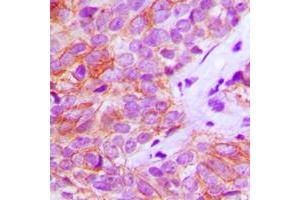Immunohistochemical analysis of FGFR3 staining in human breast cancer formalin fixed paraffin embedded tissue section.